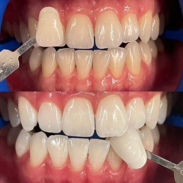 Zoom whitening does it again! These are unedited photos. The patient started with fairly light teeth but wanted to get whiter. Mission accomplished.