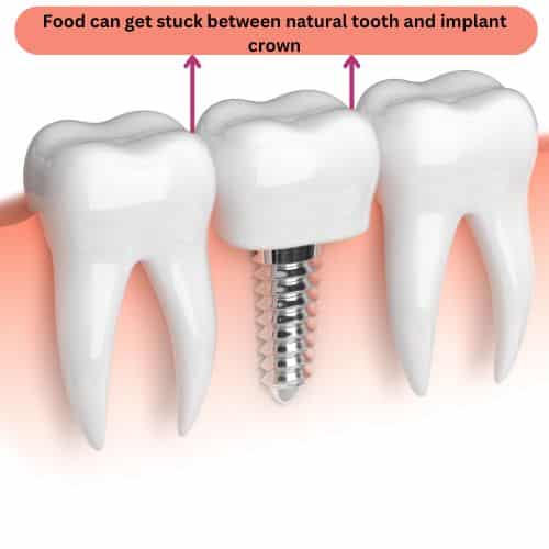 Implant