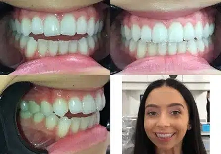 Before and after dental treatment results showing improved tooth alignment and smile transformation at Coastal Dental Arts.