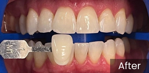 Before and after dental veneers comparison showing whitened, aligned upper front teeth transformation.