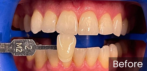 Dental shade guide comparing tooth color against natural teeth before whitening treatment.