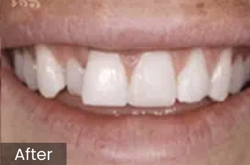 Close-up of bright white teeth showing dental whitening results after treatment.