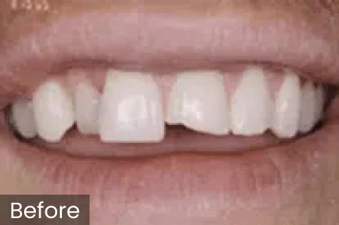 Before photo showing patient's smile with uneven, discolored front teeth requiring dental treatment