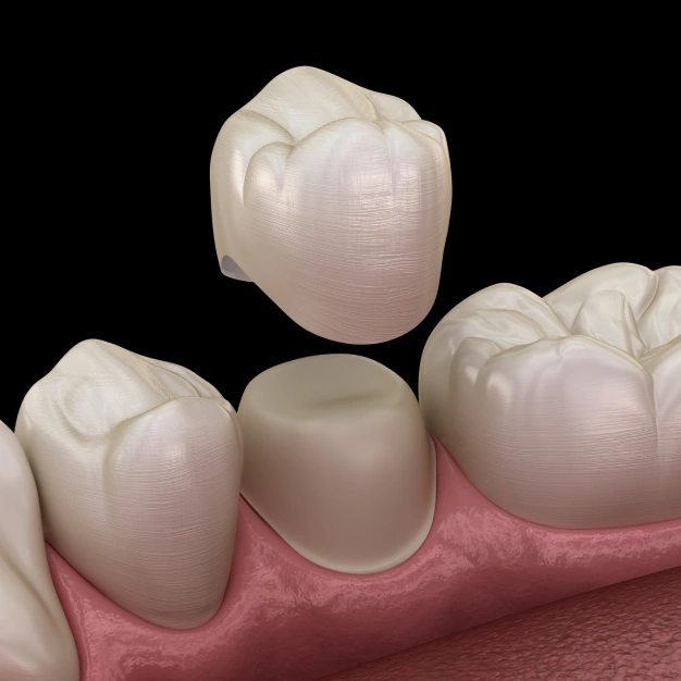 Dental crowns displayed on pink gum model showing tooth replacement options.