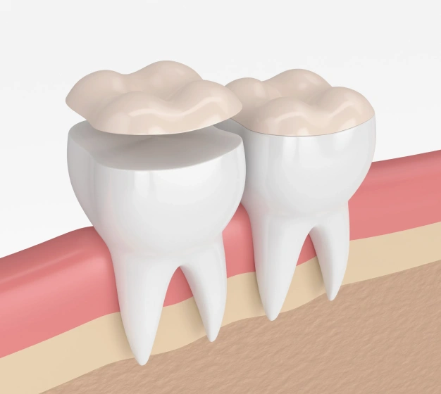 Two white tooth illustrations with gray crowns on gum tissue cross-section model.