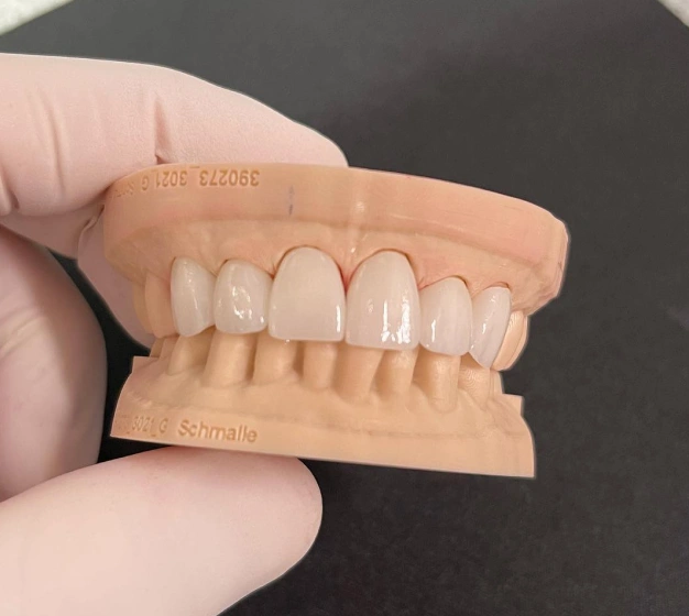 Dental model showing upper and lower teeth prosthetics held in gloved hand against dark background.