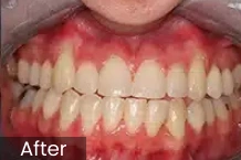 Close-up dental photograph showing teeth alignment and gum health after orthodontic treatment.