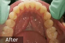 Dental patient's upper teeth and palate after orthodontic treatment, showing aligned teeth and healthy gums.