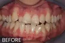 Before dental treatment showing crowded, misaligned teeth with visible gaps and discoloration.