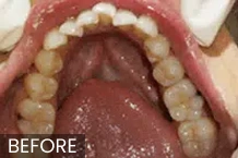 Dental patient's open mouth showing upper teeth and palate before orthodontic treatment.