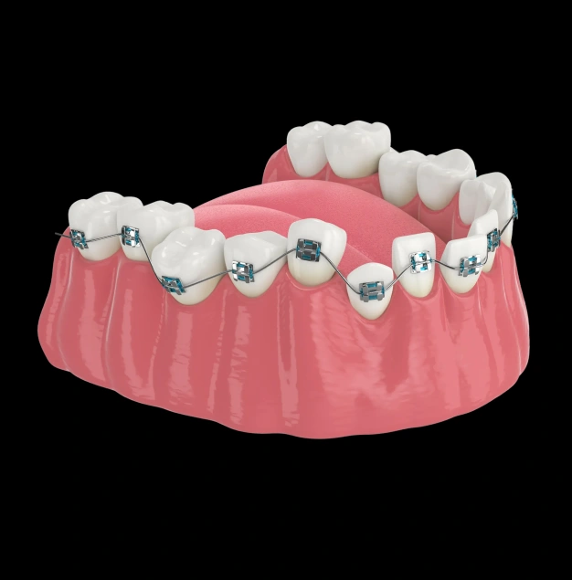 Dental implant bridge model showing prosthetic teeth attached to implant fixtures in gum tissue.