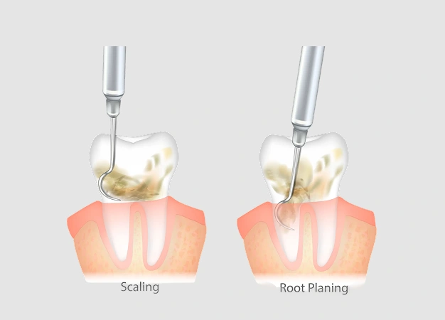 Dental scaling and root planing procedure illustration showing ultrasonic instruments above tooth cross-sections.