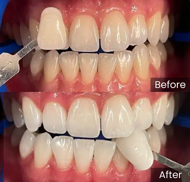 Dental whitening before and after comparison showing brightened teeth from professional treatment at Coastal Dental Arts.