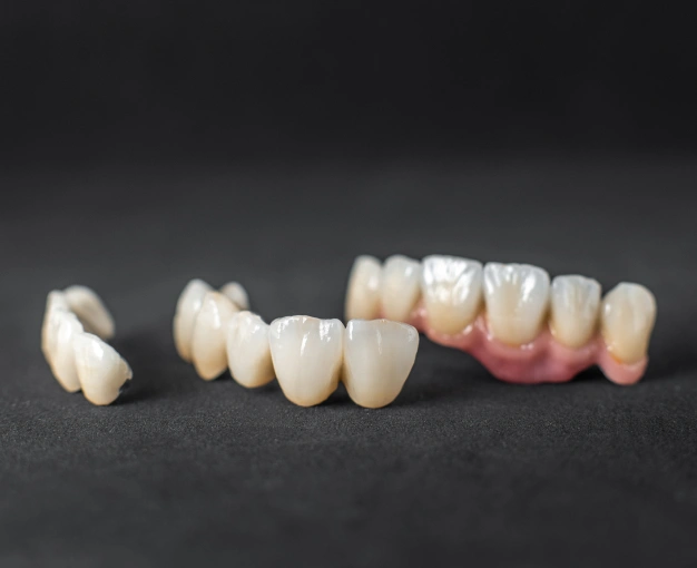 Dental crowns and bridges displayed on dark surface showing various tooth restoration options.