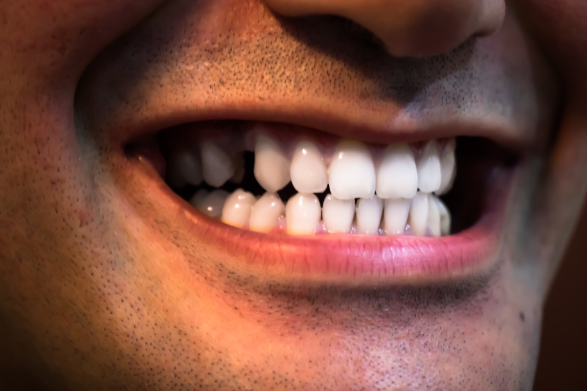 Patient displaying natural white teeth and healthy smile after dental implant treatment at Columbia Street Dental in San Die.
