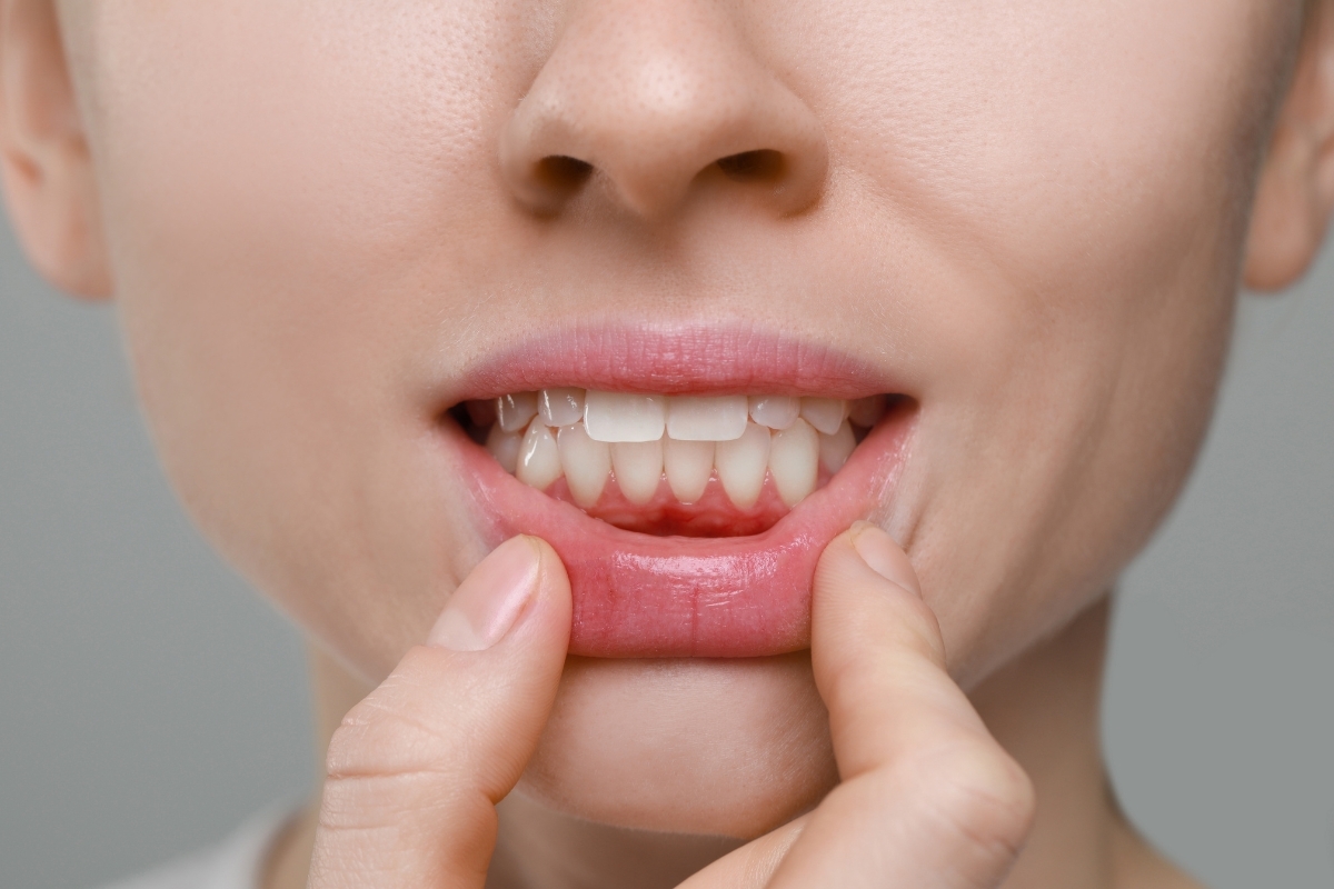 Close-up of gum recession showing exposed tooth roots and inflamed gum tissue, illustrating periodontal disease symptoms req.