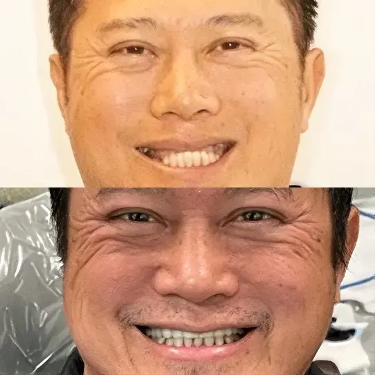 Dental implant patient results at Coastal Dental Arts