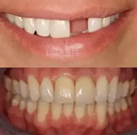 Full arch smile transformation with dental implants