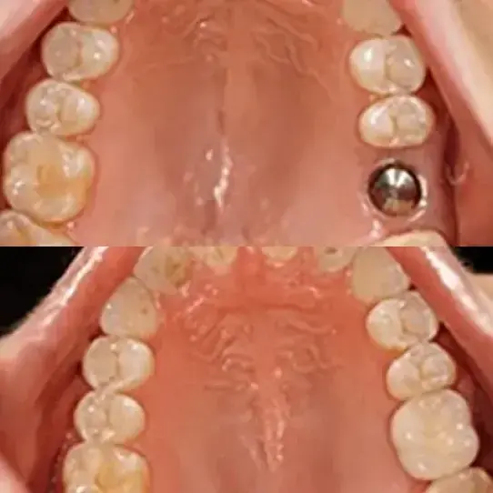 Patient before and after full arch dental implant restoration
