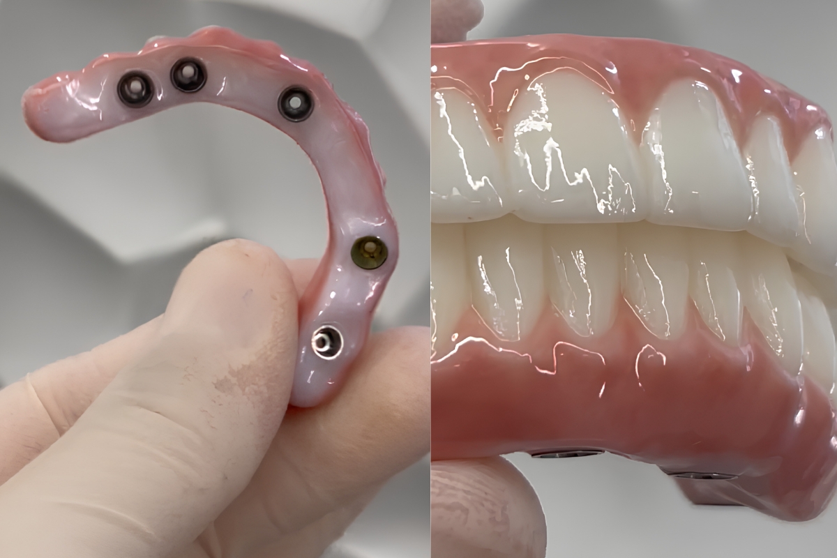 All-on-four Dental Implants in San Diego