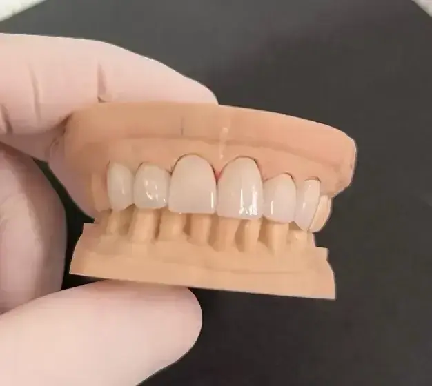 Dental veneer restoration showing natural-looking porcelain veneers on upper front teeth at San Diego cosmetic dental practi.